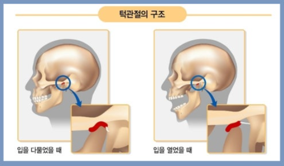 입만 크게 벌려도 딱딱 소리나는 턱관절 장애 관련 이미지