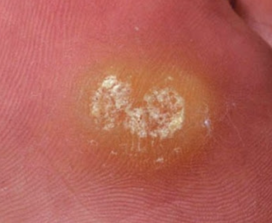 사마귀 제거방법 13