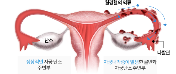여자 왼쪽 아랫배 통증 원인 7가지 왼쪽 아랫배 땡김 콕콕 찌릿 증상