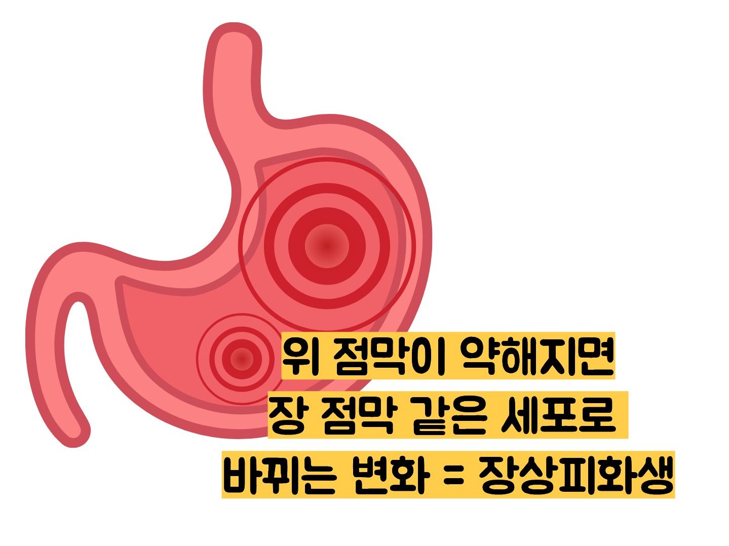 장상피화생 뜻