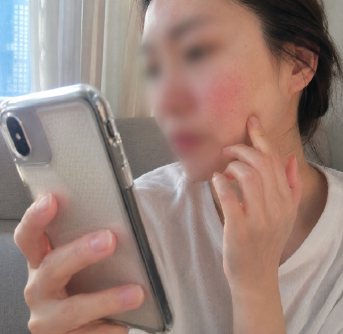 스마트폰 카메라로 얼굴의 안면홍조와 붉은기 피부 트러블 상태를 확인하고 있는 40대 여성의 일상 모습