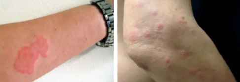 빈대 물린자국1