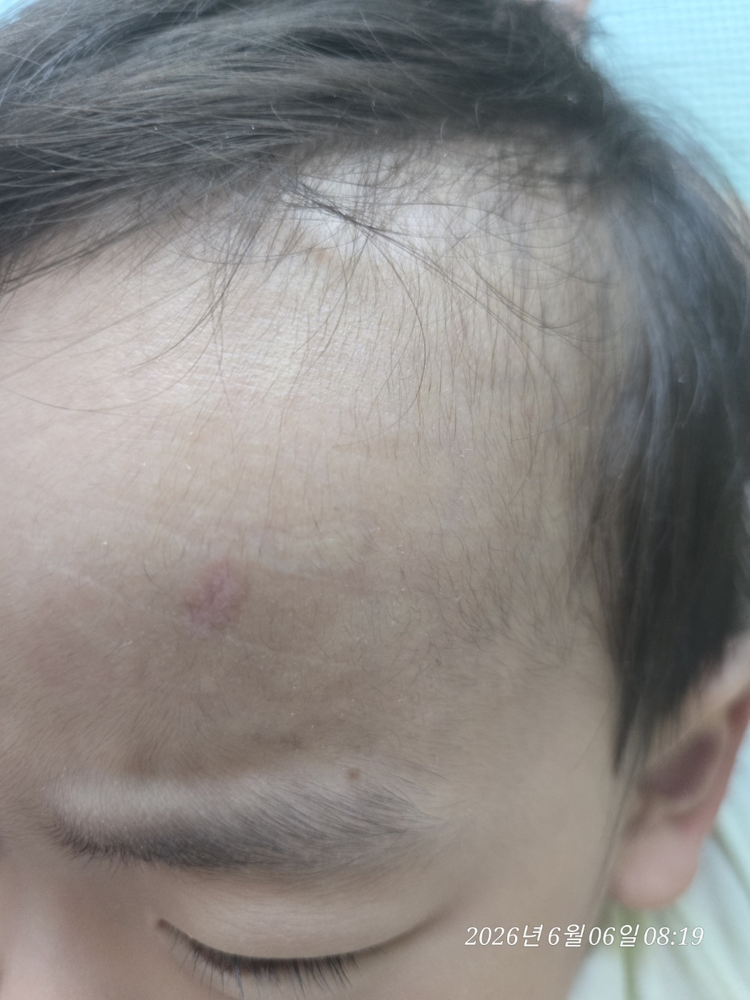 실밥을 풀고 일주일이 지난 아기 이마 흉터 2주 차 경과 모습