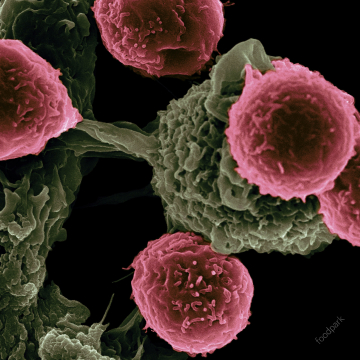 유방암 수술 후