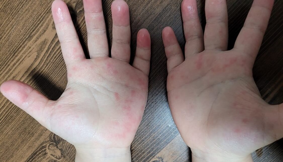 수족구 증상 예방 조치 전염 기간