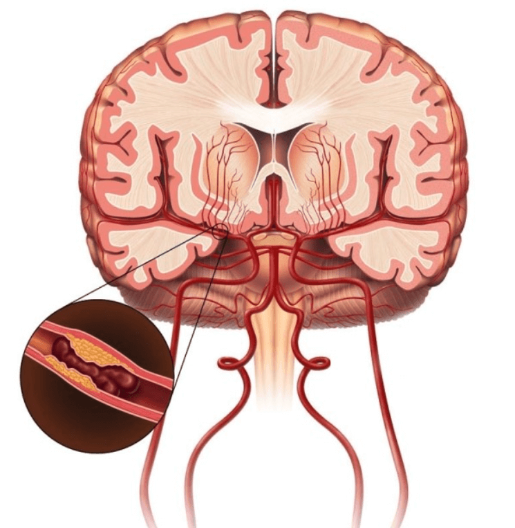 뇌경색에-좋은음식