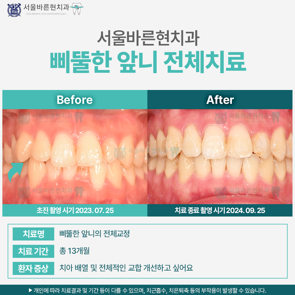 부산치아교정