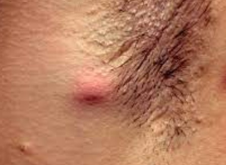 화농성 한선염 치료 방법 5가지