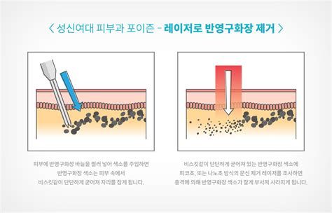 눈비립 종 제거