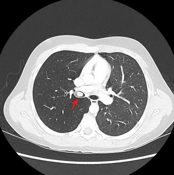 Carcinoid tumor