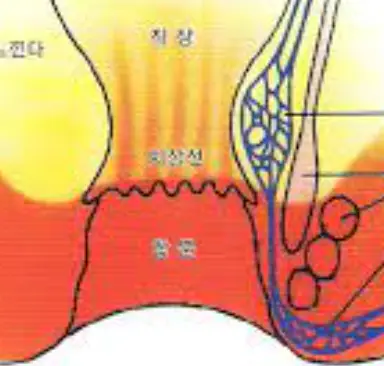 치질-증상-자가치료법-건강