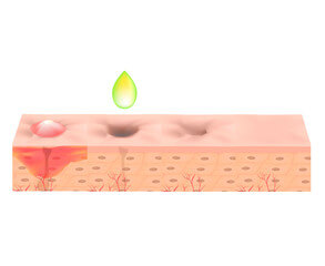 귓볼 몽우리 원인들, 뒤 피지낭종을 아시나요? 귓볼 몽우리는 귀걸이를 오래 착용한 경우 흔히 발생하기 때문에 질환이 있음에도 불구하고 방치하는 분들이 많습니다. 하지만 귓볼에 생긴 혹이 지방종이나 피지낭종과 같은 양성종양일 경우 크기가 커질 수 있다는 점을 고려하여 빠른 시일 내에 제거하는 것이 중요합니다.
