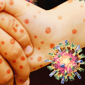 홍역 관련주 대장주 테마주 수혜주 TOP5