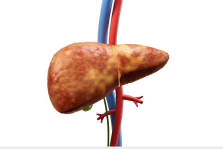 지방간 증상, 없애는 방법, 원인 총정리 (2024ver)