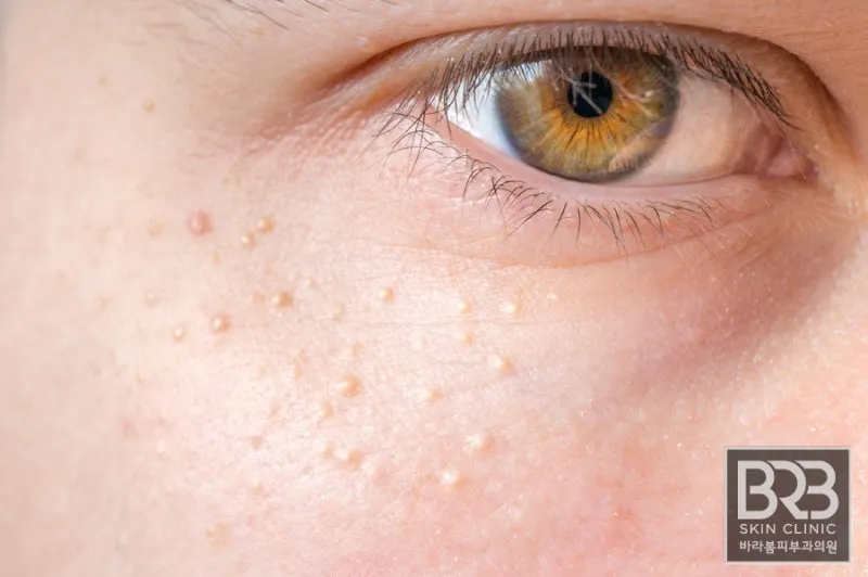 비립종 생기는 이유 비립종 없애는 방법 피부 관리법_5