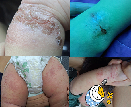 아기 아토피 관리로 식단 조절 없이 탈 스테로이드 성공한 이야기 (보습/샤워/UVB램프)