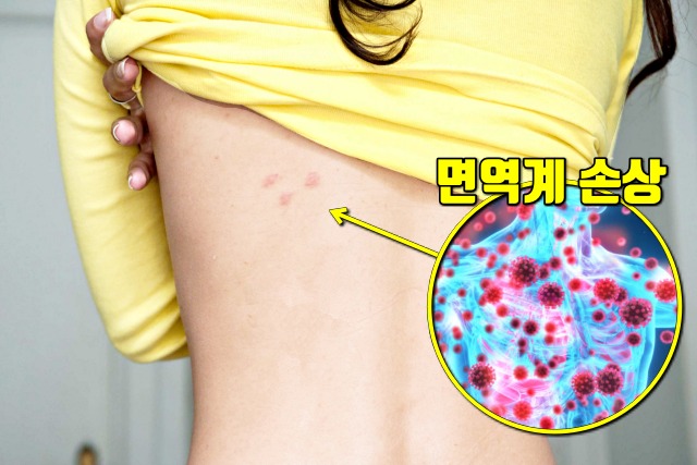 심한 스트레스 증상, 두드러기, 피부, 건강 팁줌 매일꿀정보