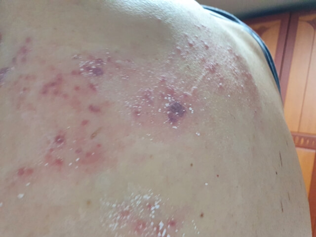 신장이식 환자의 대상포진