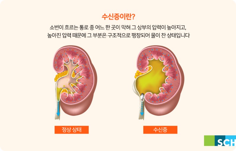 수신증