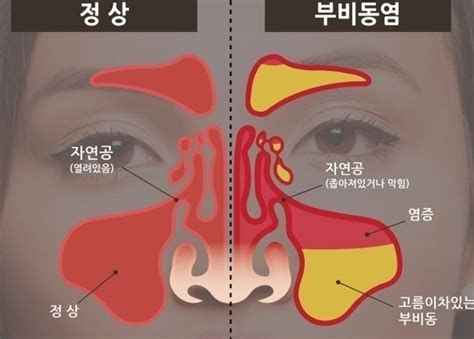 부비동염