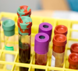 갑상선 기능 저하증 완치하는 법 진단 기준