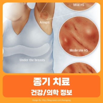 화농성 한선염 치료 수술 병원