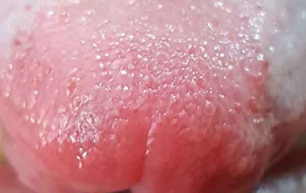 혓바닥 전체 구내염