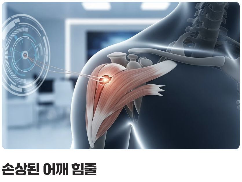 '회전근개 파열'의 정체: 찢어진 어깨 힘줄