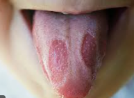 혓바늘이 돋는 이유 알아보기