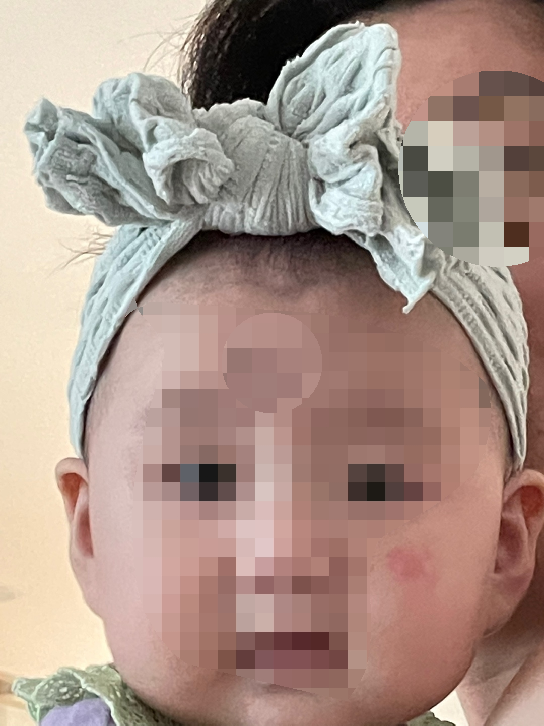 왼쪽 뺨에 동전습진 생긴 아기