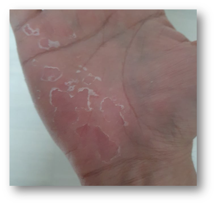 발바닥과 손바닥 껍질 벗겨짐1