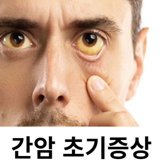 간암 초기증상