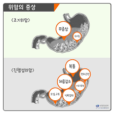 위암 초기증상
