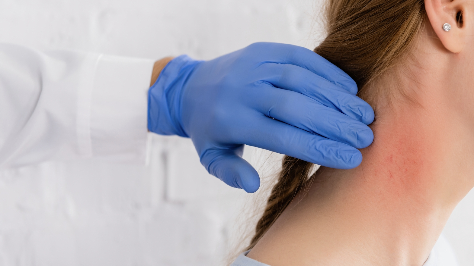 피크노제놀의 부작용