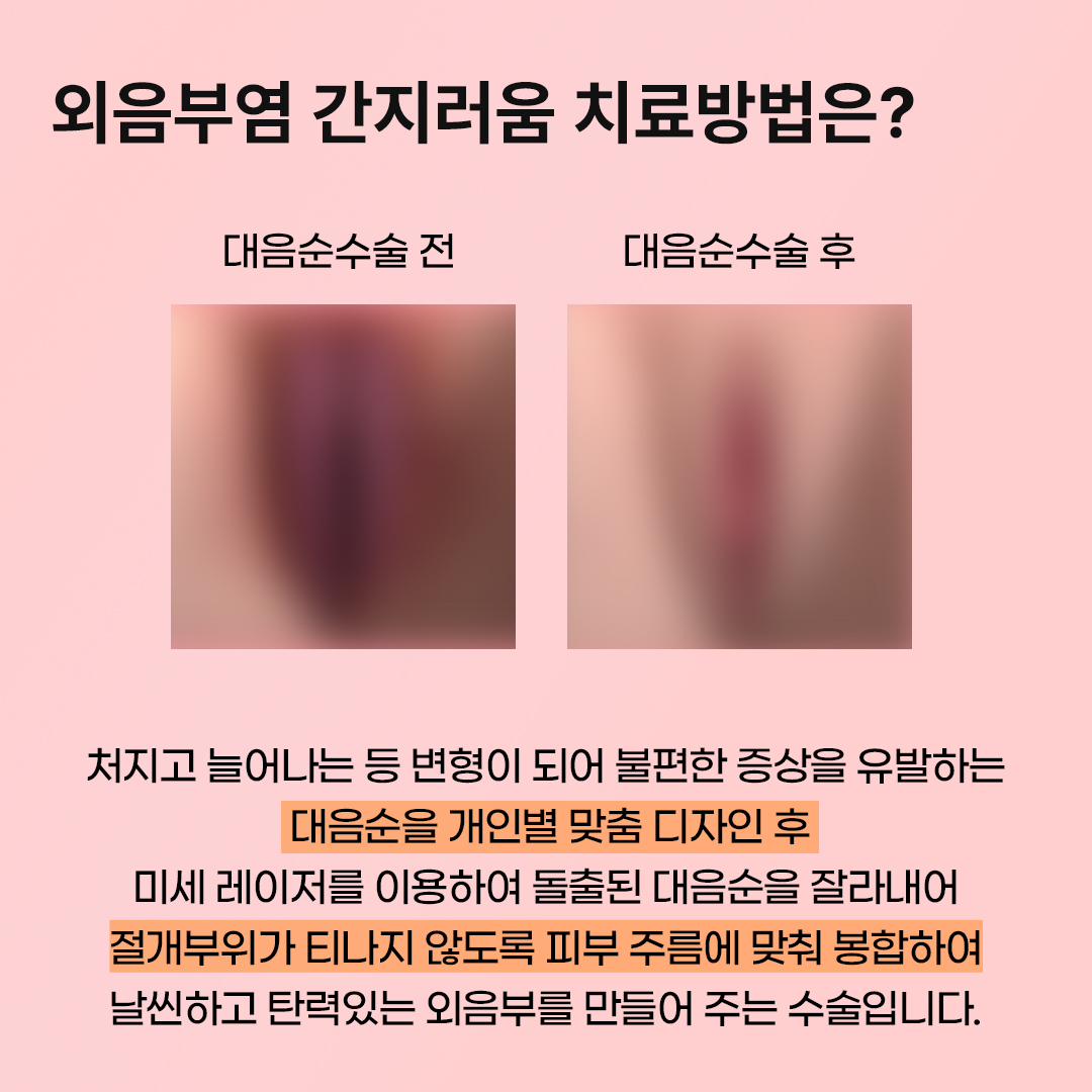 논현산부인과
외음부염 간지러움
외음부염 간지러움 치료 방법