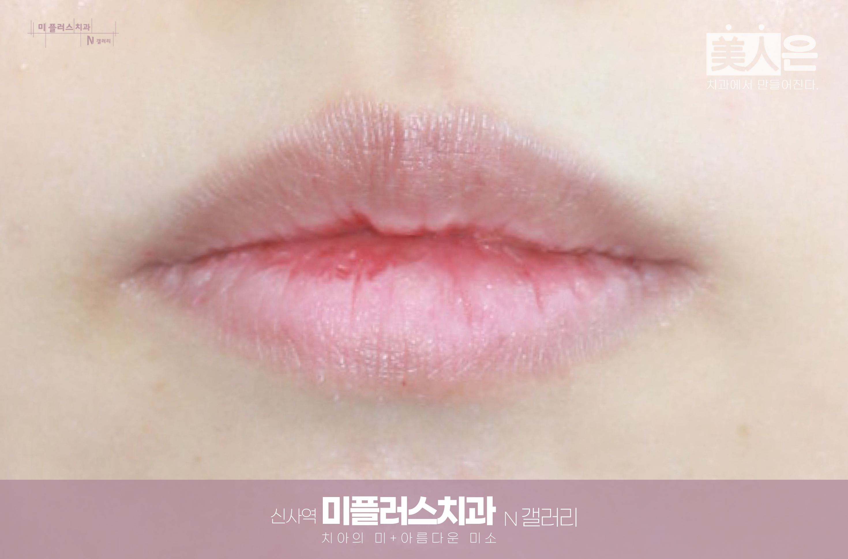 무표정에서 입꼬리가 아래로 처져 보이는 입매 모습