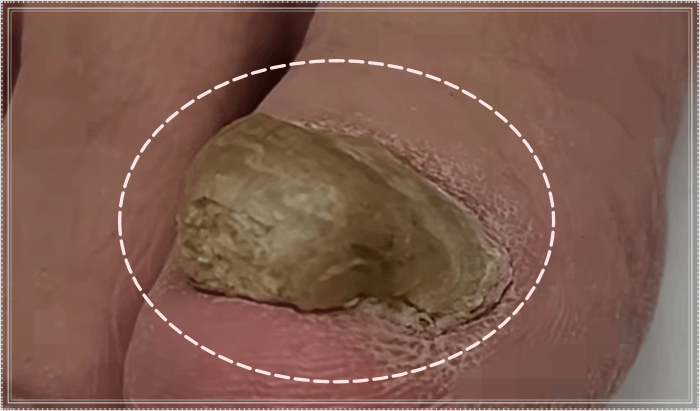 두꺼운 발톱 색깔