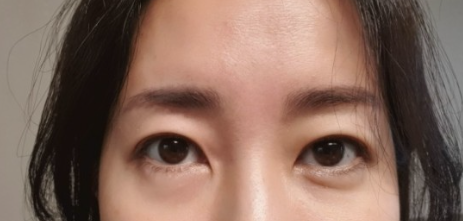 상안검 수술 후기
