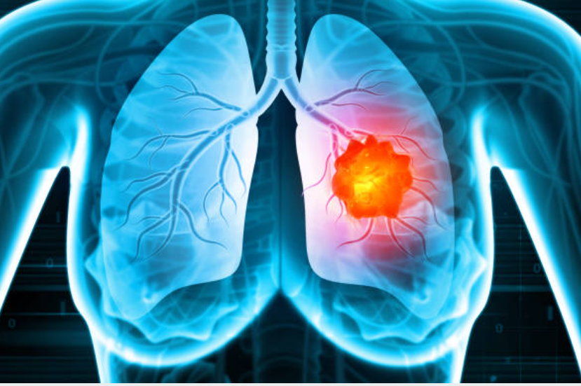 폐암과 관련된 사진