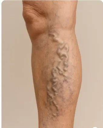 하지 정맥류 증상 치료방법과 예방 생활습관_7