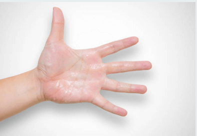 안면 다한증 치료