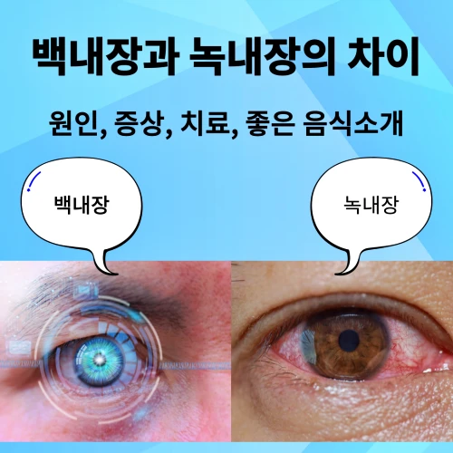 백내장과 녹내장의 차이에 대해 설명하기 위해 원인, 증상, 치료법, 좋은 음식 등에 대한 전반적 내용을 소개하는 포스팅의 대표이미지