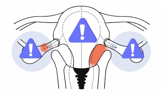 난소낭종 원인과 의심증상