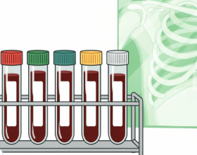 류마티스 관절염 초기증상