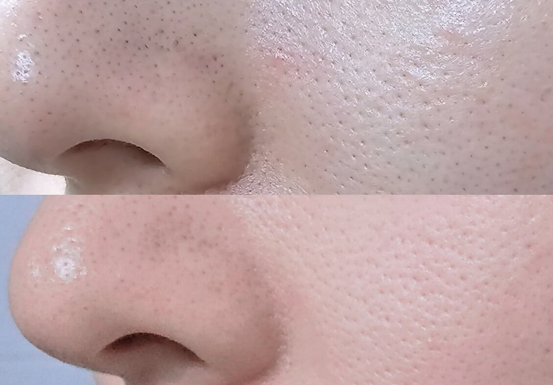모공 관리로 인해 모공이 줄어든 모습