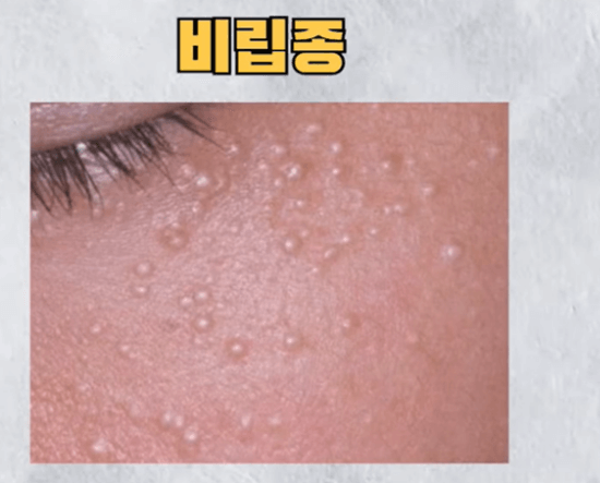 눈밑에 하얀 좁쌀