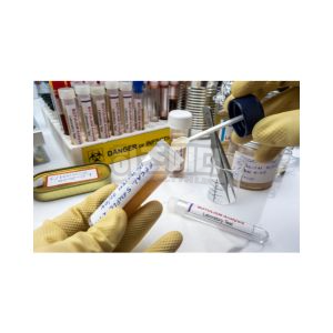 분변 잠혈검사 양성