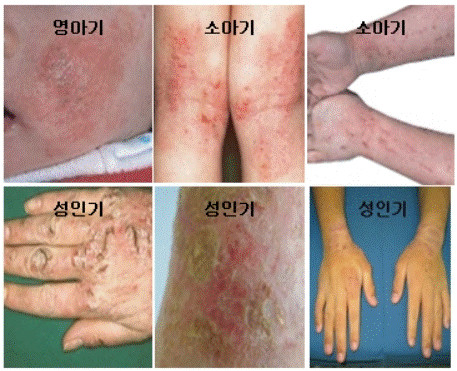 피부에 아토피염증이 생긴모습