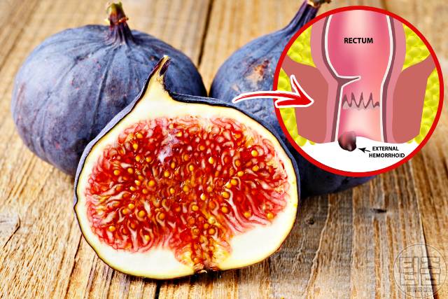 치질 자연치료 무화과