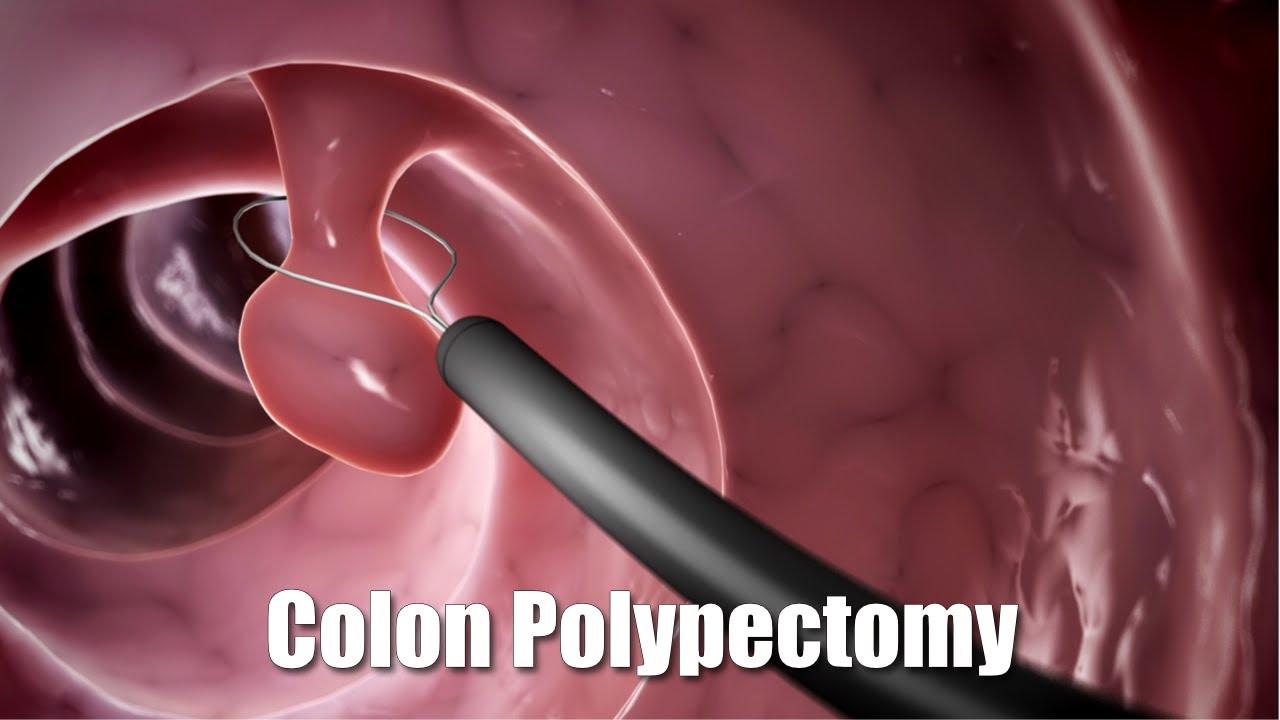 대장용종제거후주의사항